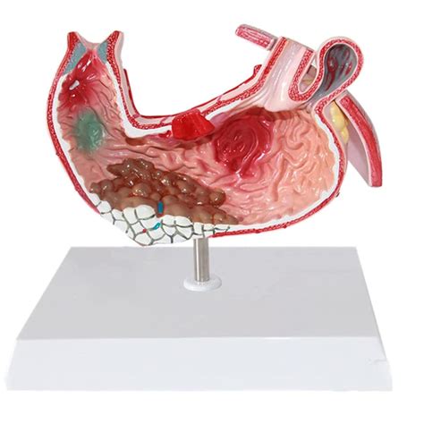 Buy Human Digestive System Model Stomach Anatomical Model Digestive System Organ Lesion Tric