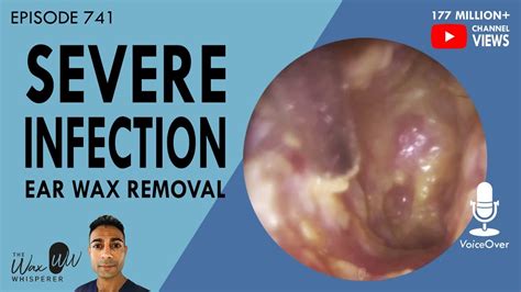 741 Severe Infection Ear Wax Removal Youtube