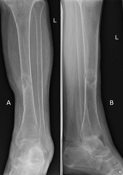 Pathological Fracture Of The Tibia As A First Sign Of