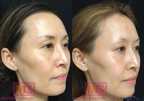 Sunspots Before And After Photos Dr Michele Green Md