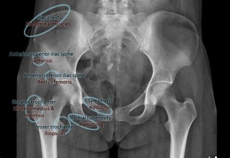Pelvic Anatomy Ischial Tuberosity The Hip Bone Ilium Ischium Pubis