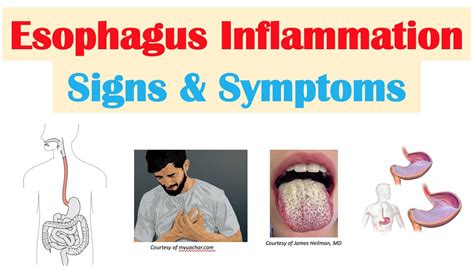 Esophagitis Esophagus Inflammation Signs And Symptoms And Why They Occur