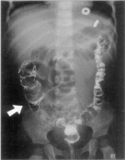 Target Sign Intussusception Abdominal X Ray Abdominal Radiography May