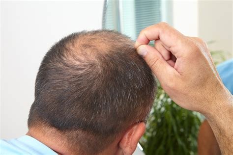Tips For Coping With Hair Loss Caused By Scalp Psoriasis Hair Loss