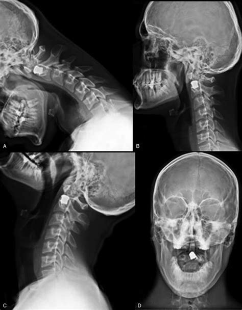 A Lateral Cervical X Ray Examination In Patients Full Flexion At