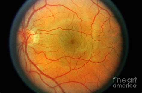 Normal Retina Photograph By Science Source