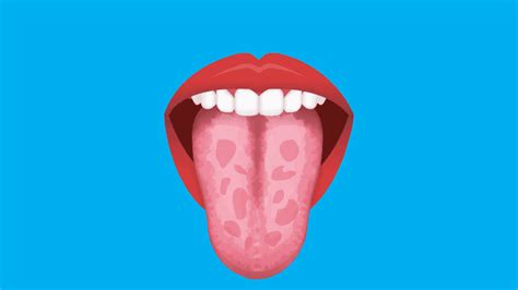 8 Reasons For Geographic Tongue And How To Treat It