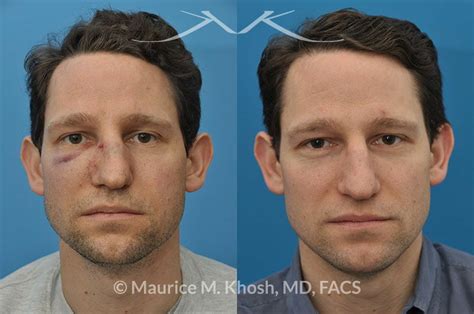 New York Facial Plastic Surgery Broken Nose Repair Facial Fracture