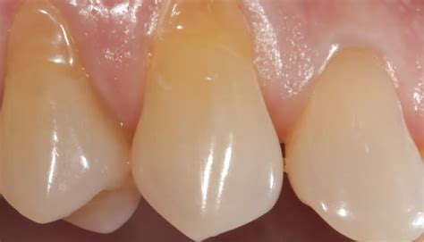 Understanding And Managing Gingival Recession Decisions In Dentistry