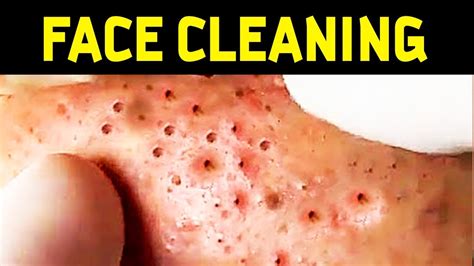 Face Cleaning Large Acne Horrible Acne Horrible Acne Explosive Explosive Acne YouTube