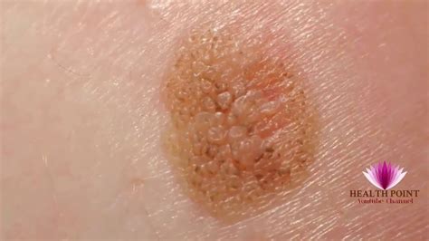Melanoma Pictures Signs Symptoms Causes Photos Images Pictures