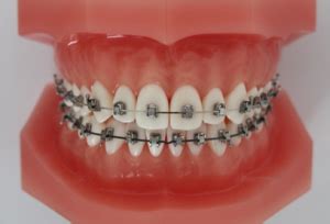 In den dentaltarifen gibt es bis zu 90 prozent (bis max. Aktiv fest - Kieferorthopädie Am Schlossplatz
