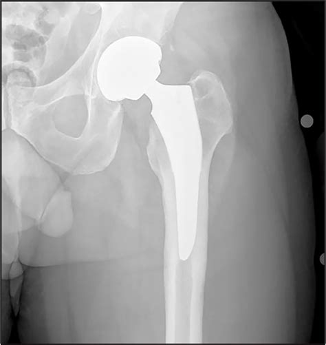 Reasons For Failure Of Primary Total Hip Arthroplasty Performed Through