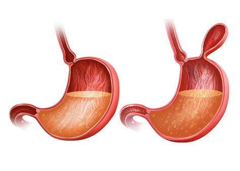 Stomach With And Without Hernia Photograph By Pixologicstudio