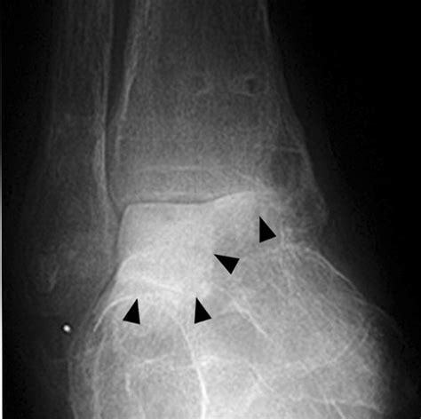 Avascular Necrosis Of The Talus A Pictorial Essay Radiographics
