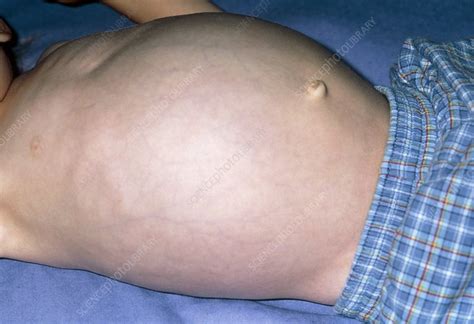 Swollen Abdomen Due To Hepatomegaly From Cancer Stock Image M