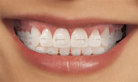 Cosmetic braces - Hydean Dental Practice