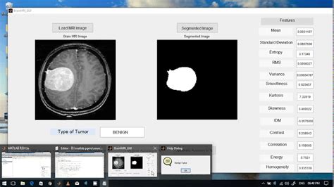 Brain Tumor Detection Using Image Processing In Matlab Youtube