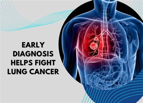 Early Diagnosis Helps Fight Lung Cancer