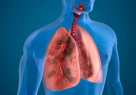 Lung Disease Pulmonary Practice