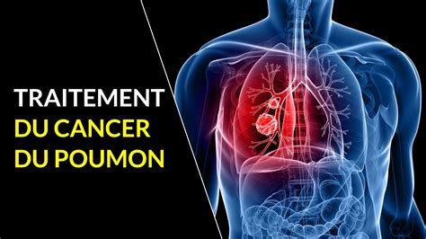 L'immunothérapie fait également l'objet d'essais cliniques dans les formes cette fois localisées (sans métastase) mais non opérables de cancer du poumon, soit environ 15 % des patients. Traitement du cancer du poumon