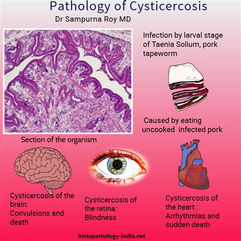 Pathology Of Cysticercosis Infectiousdisease Pathology Medicine