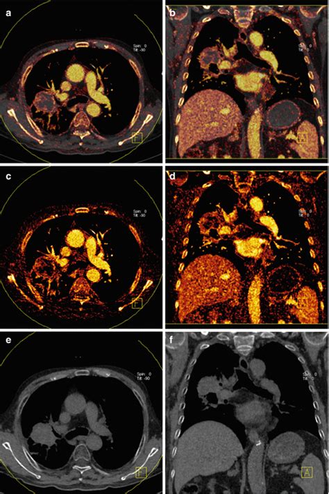 Dual Energy Ct In Chest Tumors Oncohema Key