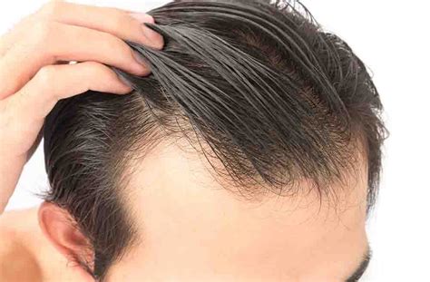 Greffe De Cheveux And Implant Capillaire En Turquie Au Meilleurs Oprix