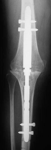 Treatment Of Infected Total Knee Replacement Concept Surgical Options