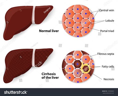 Cirrhosis of the liver is a serious health condition where the healthy tissues of the liver are replaced by rough scar tissues. Cirrhosis Liver Normal Liver Structure Liver Stock ...