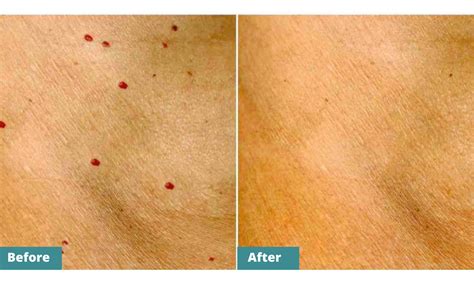 Excision Of Angiomas Red Moles Medispa Physimed