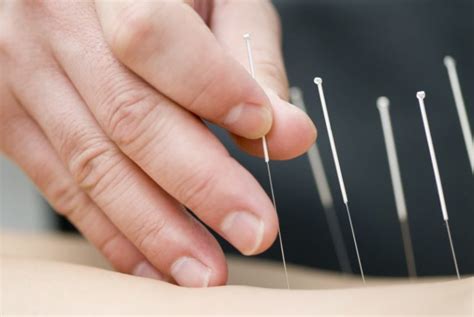 What Is Medical Acupuncture How Can It Help You