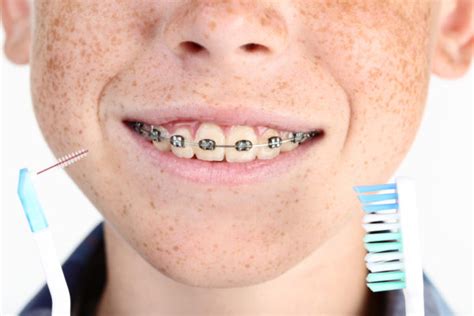 Rubber Bands And Braces Belmar Orthodontics