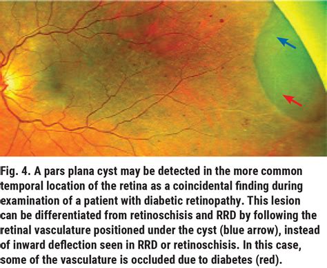 Navigating The Retinal Periphery