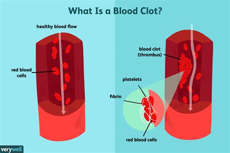It is also the symptom that appears very soon after the clots get trapped in your lungs. Blood Clot Blocks Blood Flow - Anatomicum