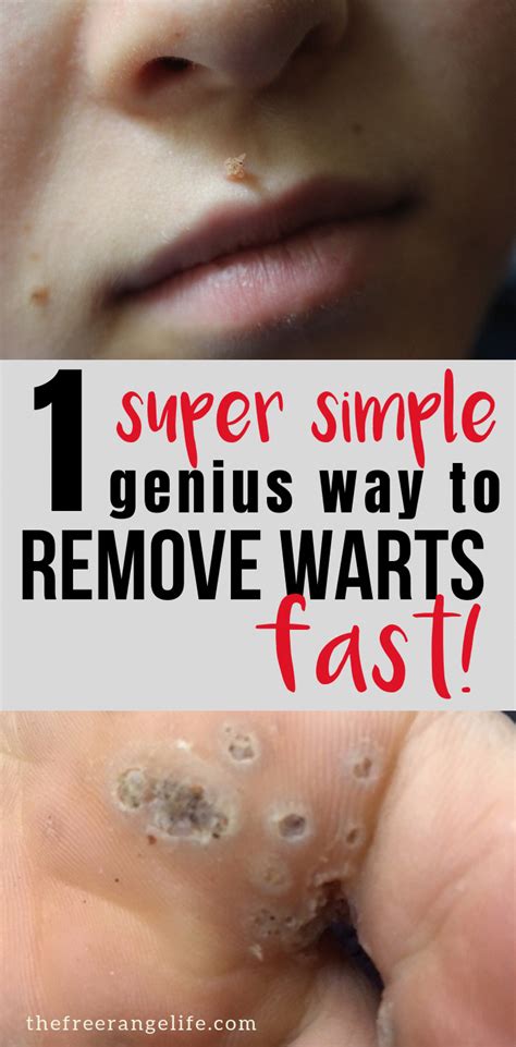 How To Get Rid Of Warts Quickly And Naturally In 2020 Get Rid Of Warts