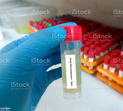 Urine Sample For Urine Microalbumin Test With Laboratory Background