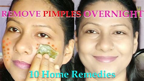 How To Remove Pimple Marks In One Day Youtube
