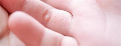 How To Get Rid Of Warts Wart Removal Process And Aftercare Tips