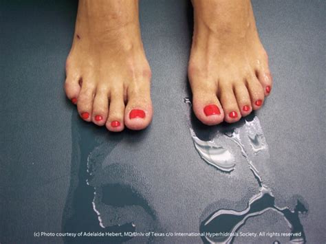 Sweaty Feet International Hyperhidrosis Society Official Site