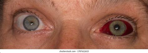 Human Eye Subconjuctival Hemorrhage Broken Blood Stock Photo 1787612615