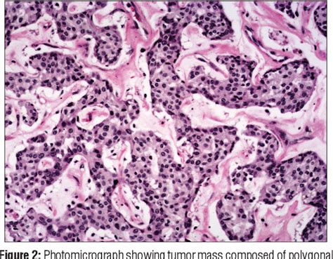 Primary Mucinous Eccrine Carcinoma Of Axillary Skin Report Of A Rare