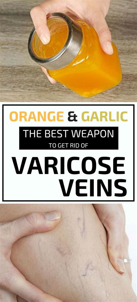 Orange And Garlic The Best Weapon To Get Rid Of Varicose Veins