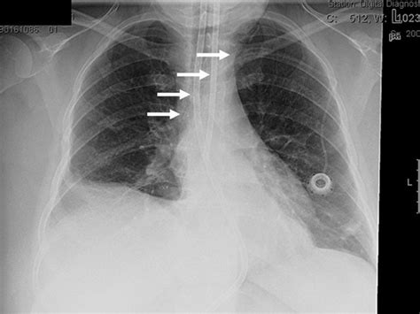 Internal jugular vein thrombosis presenting as a painful neck mass due