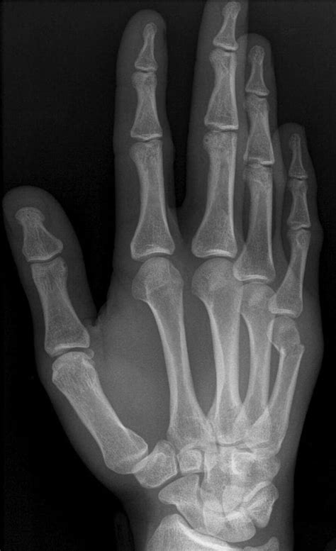 Boxer S Fracture LITFL Trauma Library