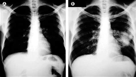 Tuberculosis Associated Immune Reconstitution Inflammatory Syndrome