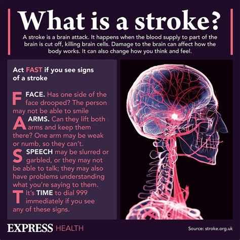 Stroke Symptoms Eight Subtle Signs Of A Brain Attack Call 999 Now