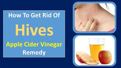 How To Get Rid Of Hives Apple Cider Vinegar Remedy Youtube