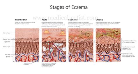 What Is Skin Eczema Health Life Media
