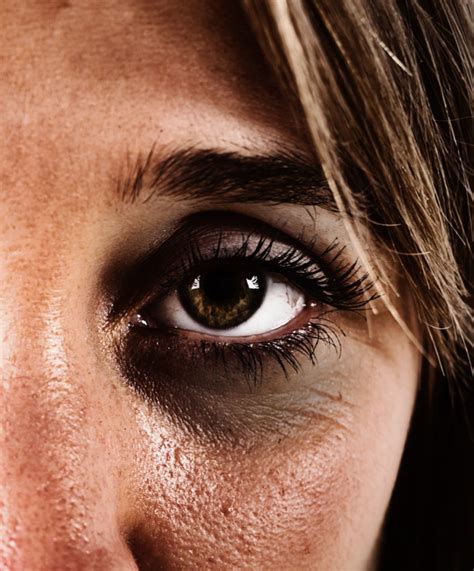 Dark Circles Under Eyes Treatments Hair And Skin Science